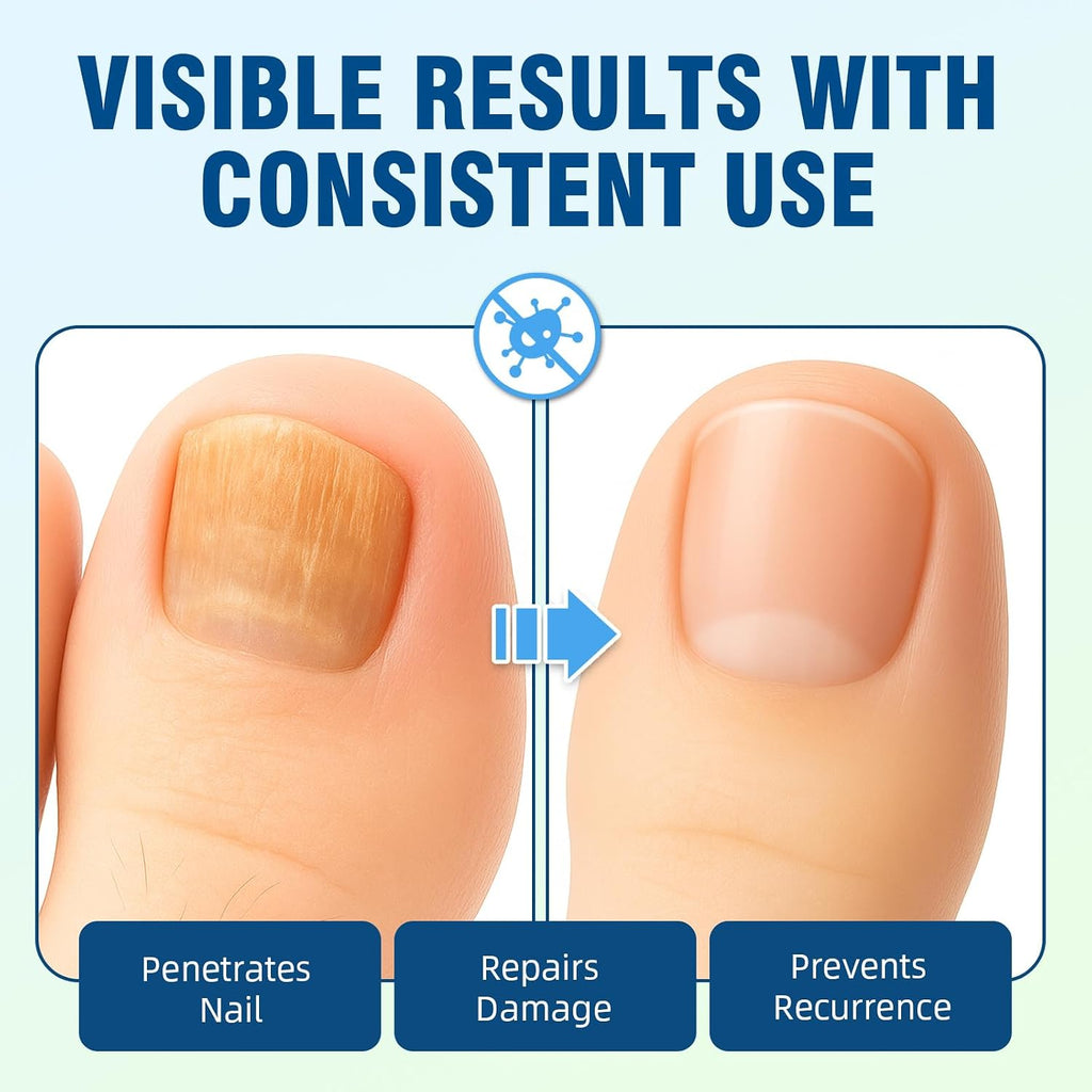 Extra Strength Toenail Fungus Treatment – Nail Repair Solution to Restore Damaged, Discolored, and Brittle Nails with Fast-Acting Natural Formula for Healthy Growth, 30Ml